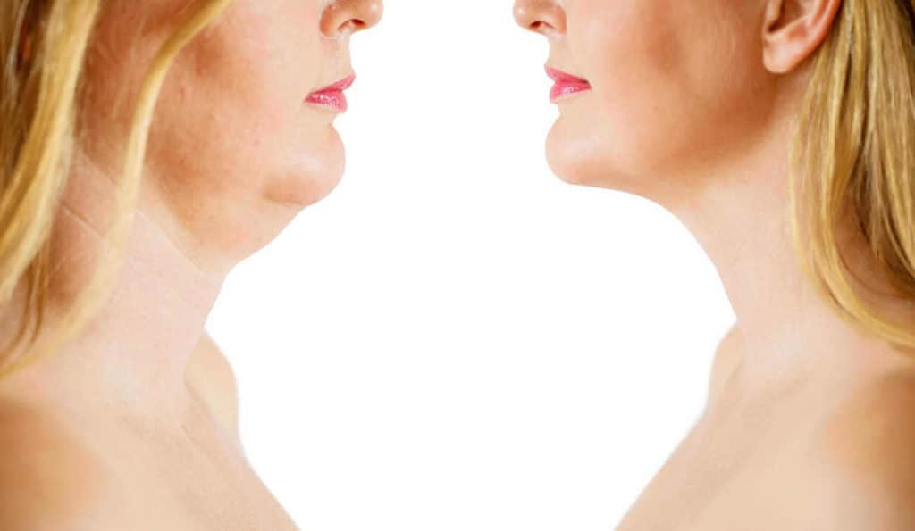 Double Chin treatment Bovingdon before and after results