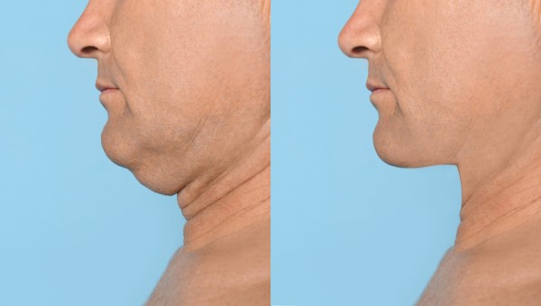 Which Non-Surgical Treatments Work Best for Jowls and Loose Skin Bovingdon?