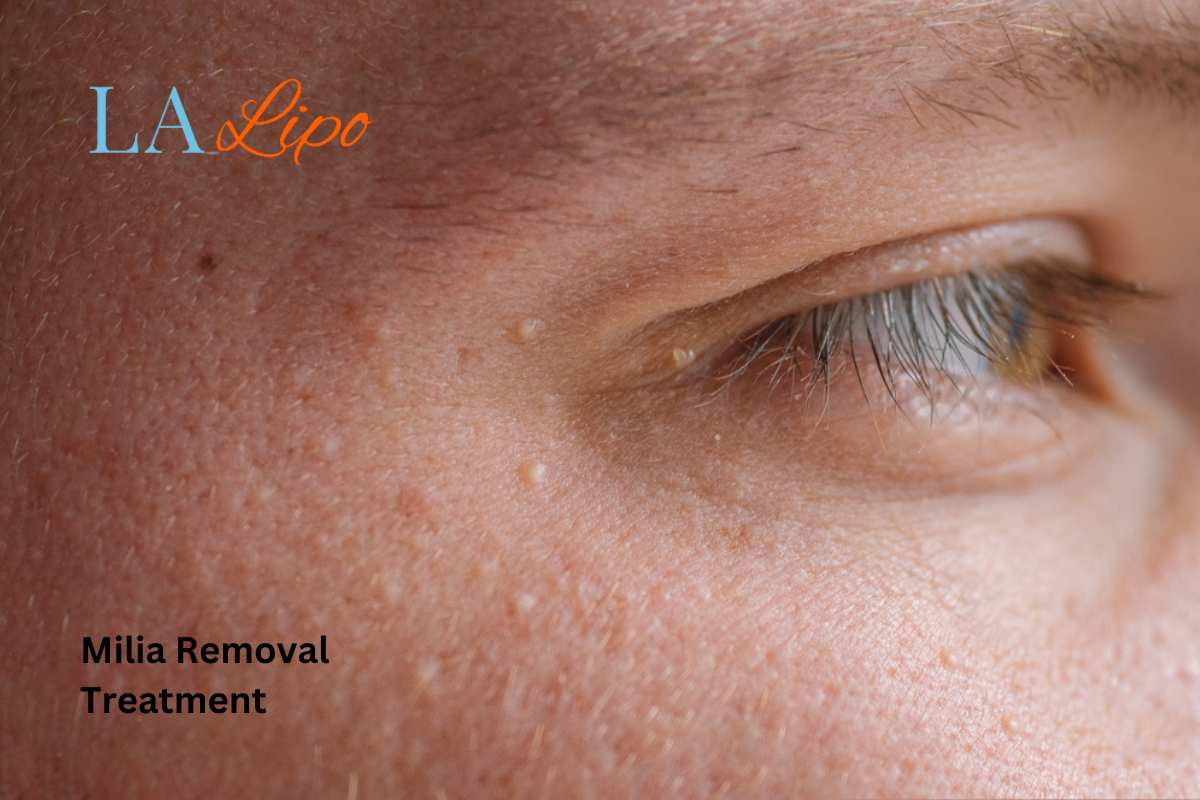 Cryopen Milia Removal: Is It the Easiest and Safest Option Bovingdon?