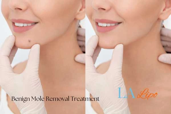 Before-and-after results following benign mole-removal treatment Bovingdon