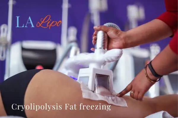 women getting fat freezing Bovingdon