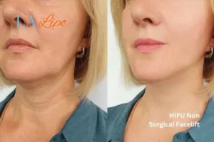 hi-fu for wrinkles Bovingdon before and after results