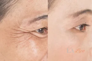 Before and after results of woman - HI-fu wrinkles reduction treatment Bovingdon
