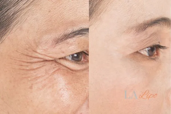 Before and after results of woman - HI-fu wrinkles reduction treatment Bovingdon