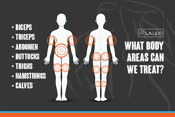 Graphic to show areas you can have LA-EMS Body Sculpting Bovingdon treatment.