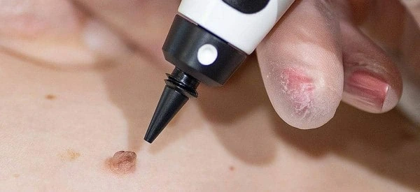 skin tag removal using cryopen Bovingdon