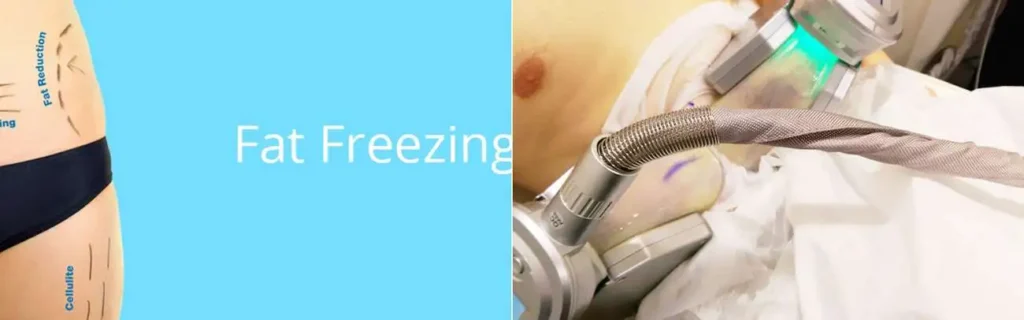 Fat freezing Bovingdon on multiple areas of the body