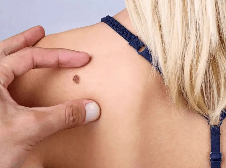 woman having mole removal Bovingdon consultation before treatment.