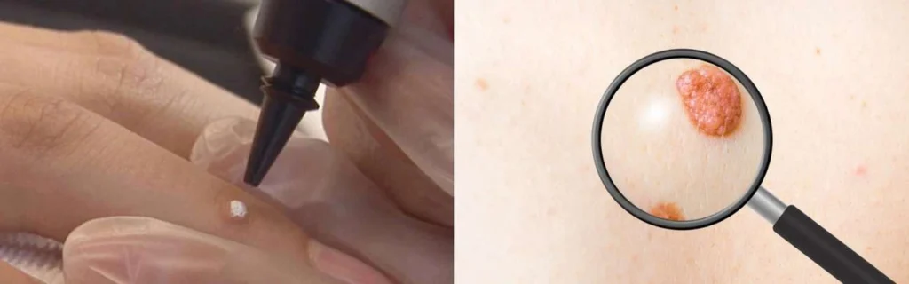 CryoPen practitioner Bovingdon assessing a benign mole before treatment