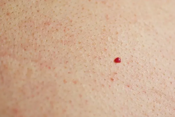 close up of a cherry angioma Bovingdon