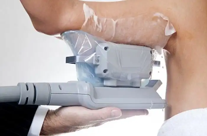 Picture of fat freezing Bovingdon on the upper arms.