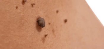 image of a skin tag Bovingdon