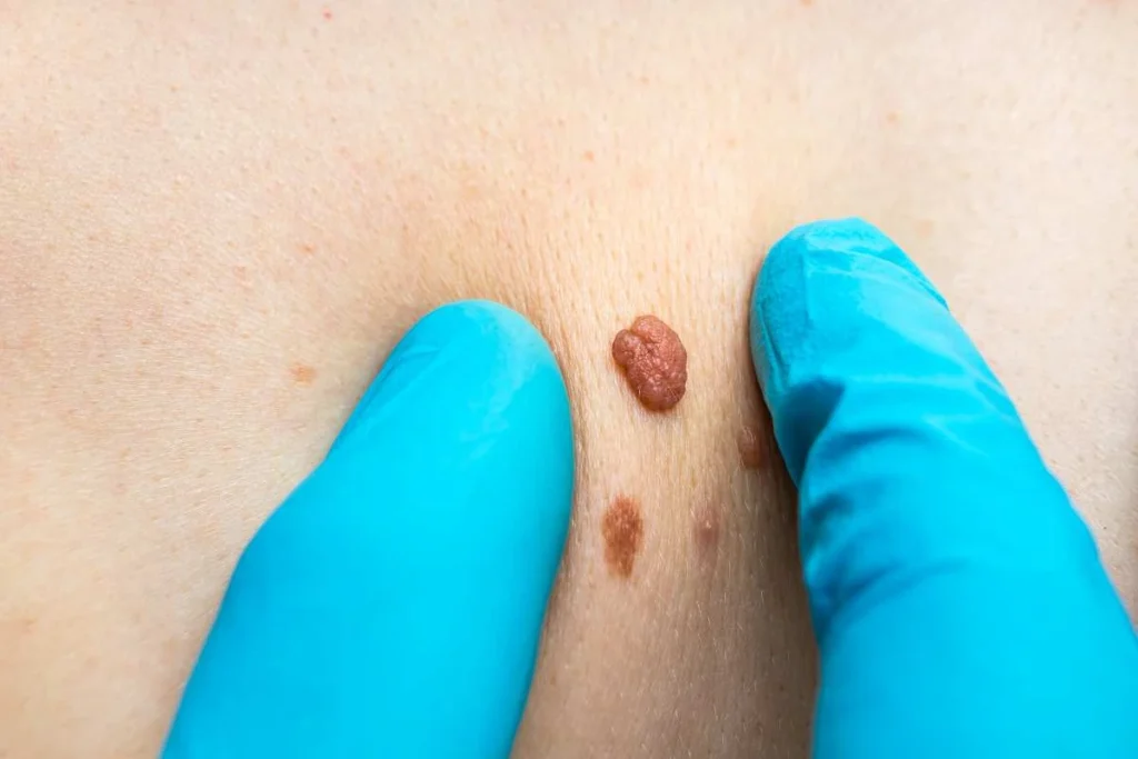 Consultant examining a skin tag Bovingdon