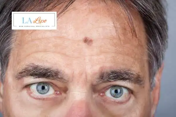 Solar Lentigo Removal Bovingdon image of man with mark on his forehead