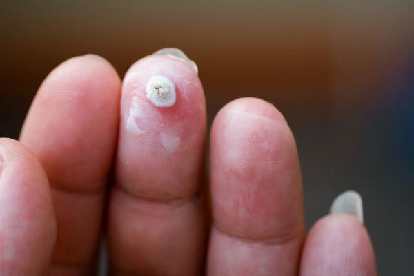 wart on person finger - cryotherapy to treat from LA LIPO Bovingdon