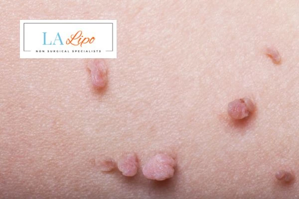 Does cryopen skin tag removal Bovingdon hurt? Find out now call our team today!