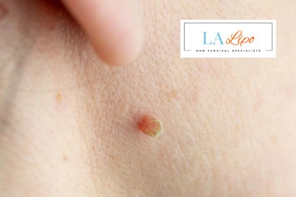 Book skin tag removal Bovingdon today speak to our team now!