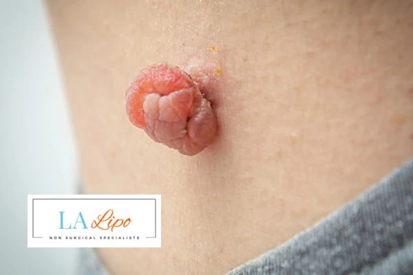 Interested in skin tag removal Bovingdon? Concerned about the pain? Find out more today!