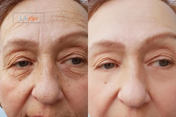 The powerful benefits of Morpheus8 Treatment Bovingdon - Call Our team today!