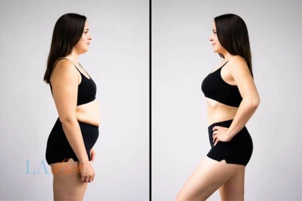 Picture of womans before and after using LA-EMS body sculpting to improve her core strength Bovingdon