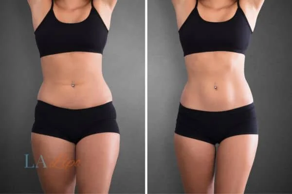 before and after results of non-surgical treatment to help a woman's body image and mental health Bovingdon