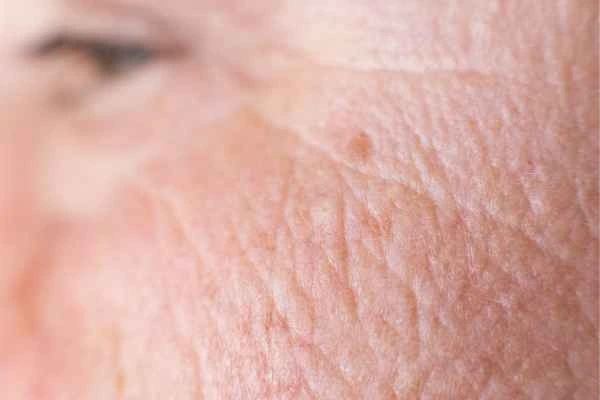 close up picture of a woman's face showing an age spot Bovingdon