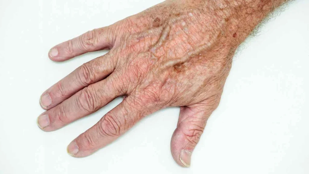 Male hand showing age spot Bovingdon