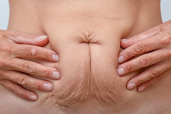 Should I Combine Diastasis Recti Treatment with Body Contouring for Better Results Bovingdon?