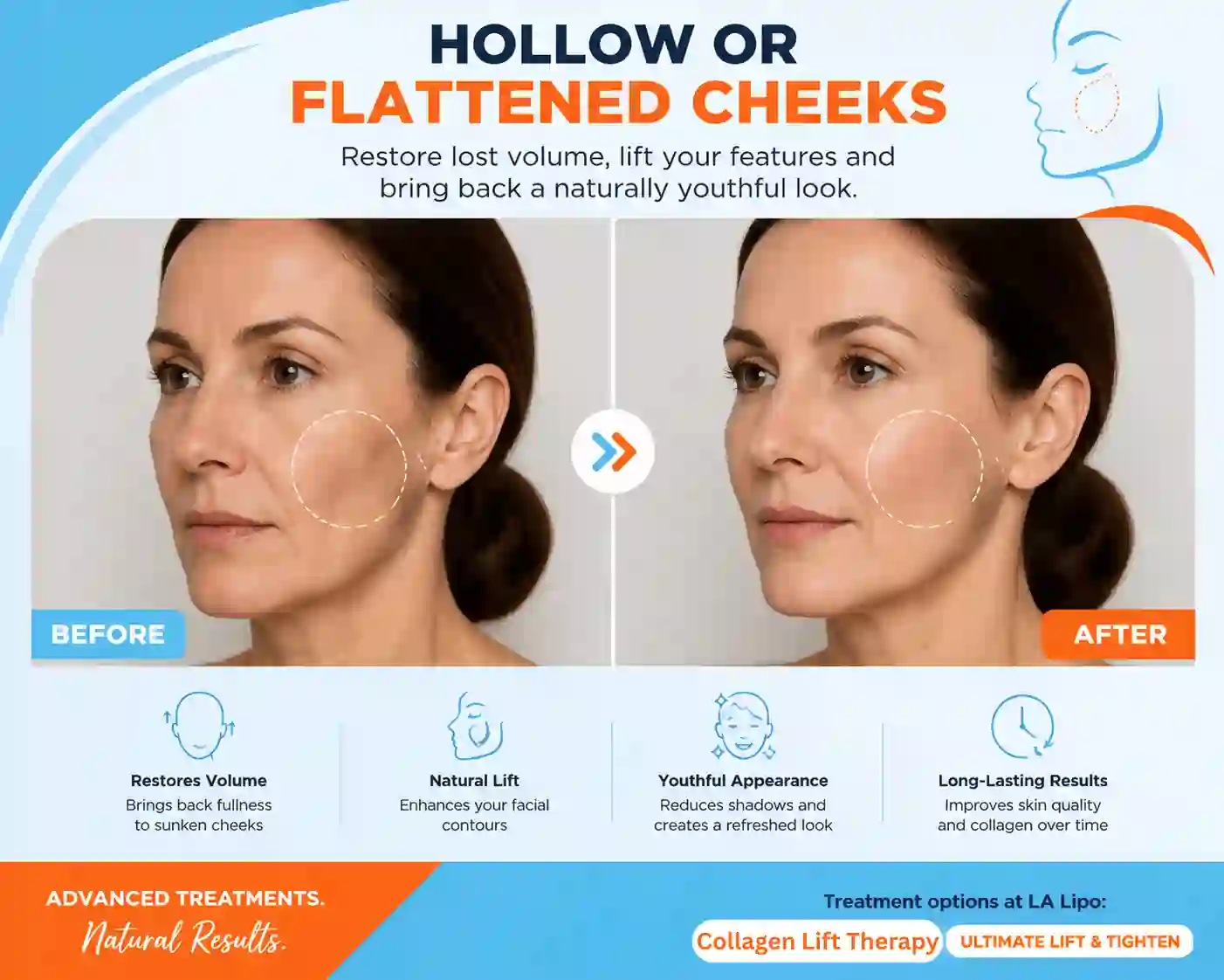 Sign #4: Hollow or Flattened Cheeks Bovingdon