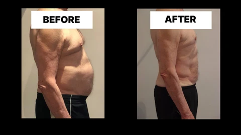 What Symptoms Can Diastasis Recti Cause in Men? Weak Core, Back Pain and Poor Posture Bovingdon